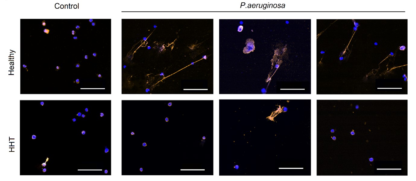 AG Morbus Osler / Hereditäre Hämorrhagische Teleangiektasie - Klinik ...